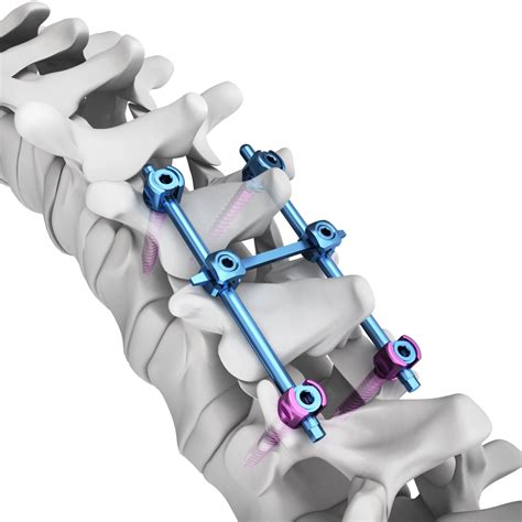 spinal implant for parkinson's